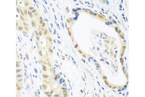 Immunohistochemistry of paraffin-embedded Human stomach cancer using POLR2E Polyclonal Antibody at dilution of 1:100 (40x lens).