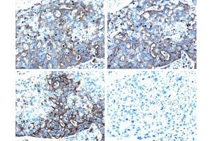 Ezrin (pT567) staining on human breast cancer. (Ezrin Antikörper  (pThr567))