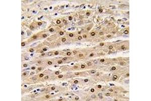 IHC analysis of FFPE human hepatocarcinoma tissue stained with anti-GAPDH antibody (GAPDH Antikörper  (AA 62-91))