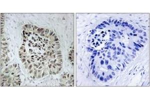 Immunohistochemistry analysis of paraffin-embedded human lung carcinoma tissue, using Artemis (Ab-516) Antibody. (DCLRE1C Antikörper  (AA 482-531))
