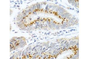 Immunohistochemistry of paraffin-embedded Human colon carcinoma using FAM3B Polyclonal Antibody at dilution of 1:100 (40x lens). (FAM3B Antikörper)