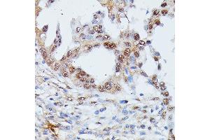 Immunohistochemistry of paraffin-embedded human lung cancer using IGHMBP2 antibody (ABIN7267848) at dilution of 1:100 (40x lens). (IGHMBP2 Antikörper  (AA 540-720))