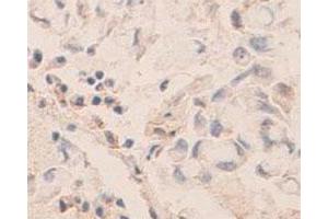 Immunohistochemical staining of formalin-fixed paraffin-embedded human lung carcinoma tissue showing membrane and nuclear staining with PDCD6 polyclonal antibody  at 1 : 100 dilution. (PDCD6 Antikörper)