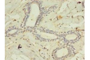 Immunohistochemistry of paraffin-embedded human breast cancer using ABIN7158507 at dilution of 1:100 (ACSL4 Antikörper  (AA 457-670))