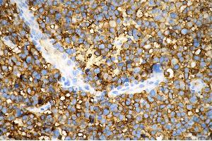 Immunohistochemistry was performed on paraffin-embedded human glioblastoma using tubulin III antibody (ABIN7800669), 1:500). (Rekombinanter TUBB3 Antikörper)