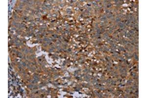 The image on the left is immunohistochemistry of paraffin-embedded Human cervical cancer tissue using ABIN7191748(OTOR Antibody) at dilution 1/30, on the right is treated with synthetic peptide. (Otoraplin Antikörper)