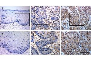 Immunohistochemical staining of TEAD4 in human HNSCC samples. (TEAD4 Antikörper  (Center))