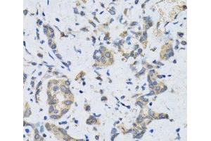 Immunohistochemistry of paraffin-embedded Human gastric cancer using SLC2A13 Polyclonal Antibody at dilution of 1:100 (40x lens). (SLC2A13 Antikörper)