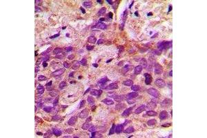 Immunohistochemical analysis of ACSS1 staining in human prostate cancer formalin fixed paraffin embedded tissue section. (ACSS1 Antikörper  (C-Term))