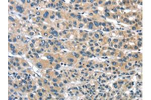 The image on the left is immunohistochemistry of paraffin-embedded Human liver cancer tissue using ABIN7192957(TUSC1 Antibody) at dilution 1/30, on the right is treated with synthetic peptide. (TUSC1 Antikörper)