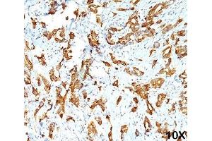 IHC testing of human breast carcinoma (10X) stained with HSP27 antibody (G3. (HSP27 Antikörper)