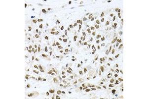 Immunohistochemistry of paraffin-embedded human lung cancer using BCCIP antibody. (BCCIP Antikörper  (AA 1-314))
