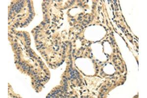 The image on the left is immunohistochemistry of paraffin-embedded Human thyroid cancer tissue using ABIN7130215(MED16 Antibody) at dilution 1/20, on the right is treated with fusion protein. (MED16 Antikörper)