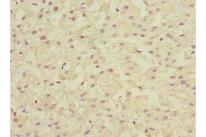 Immunohistochemistry of paraffin-embedded human liver cancer using ABIN7157915 at dilution of 1:100 (LSS Antikörper  (AA 1-300))