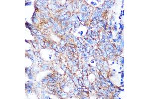 Immunohistochemistry of paraffin-embedded human breast cancer using Flotillin 1 Rabbit mAb (ABIN3017206, ABIN3017207, ABIN1680028 and ABIN1680029) at dilution of 1:100 (40x lens). (Flotillin 1 Antikörper)