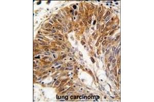 Formalin-fixed and paraffin-embedded human lung carcinoma tissue reacted with PSMD11 antibody (C-term), which was peroxidase-conjugated to the secondary antibody, followed by DAB staining. (PSMD11 Antikörper  (C-Term))