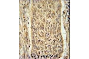 INMT Antibody (Center) (ABIN651667 and ABIN2840351) immunohistochemistry analysis in formalin fixed and paraffin embedded human lung carcinoma followed by peroxidase conjugation of the secondary antibody and DAB staining. (INMT Antikörper  (AA 101-128))