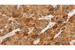 Immunohistochemistry of paraffin-embedded Human liver cancer tissue using LTB Polyclonal Antibody at dilution 1:45 (LTB Antikörper)