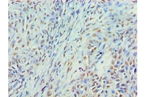 Immunohistochemistry of paraffin-embedded human breast cancer using ABIN7160405 at dilution of 1:100 (MYEF2 Antikörper  (AA 372-576))