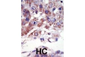 Formalin-fixed and paraffin-embedded human cancer tissue reacted with the primary antibody, which was peroxidase-conjugated to the secondary antibody, followed by AEC staining. (JNK2 Antikörper  (C-Term))
