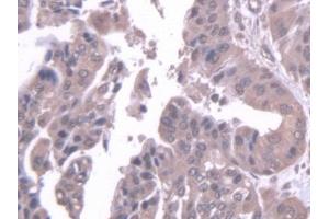 Detection of STK39 in Human Liver cancer Tissue using Polyclonal Antibody to Serine/Threonine Kinase 39 (STK39) (STK39 Antikörper  (AA 63-545))