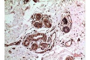 Immunohistochemistry (IHC) analysis of paraffin-embedded Human Breast Cancer, antibody was diluted at 1:100. (IL-10 Antikörper  (Internal Region))