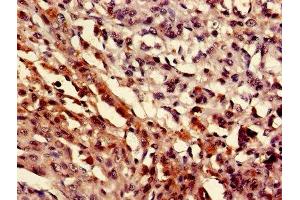 IHC image of ABIN7160506 diluted at 1:400 and staining in paraffin-embedded human melanoma performed on a Leica BondTM system.