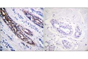 Immunohistochemistry analysis of paraffin-embedded human breast carcinoma tissue, using IRAK1 (Ab-209) Antibody. (IRAK1 Antikörper  (AA 175-224))