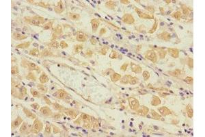 Immunohistochemistry of paraffin-embedded human gastric cancer using ABIN7173562 at dilution of 1:100 (Tropomyosin 4 Antikörper  (AA 1-248))