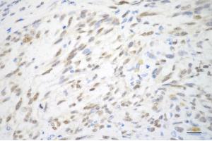 Immunohistochemistry was performed on paraffin-embedded human breast carcinoma using TFAP2A antibody (ABIN7800591), 1:200).