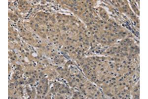 The image on the left is immunohistochemistry of paraffin-embedded Human gastric cancer tissue using ABIN7128303(AGTRAP Antibody) at dilution 1/40, on the right is treated with fusion protein. (AGTRAP Antikörper)