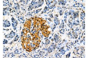 ABIN6265623 and ABIN6277829 at 1/100 staining Human pancreatic cancer and adjacent nomal tissues by IHC-P. (TMX2 Antikörper  (N-Term))