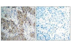 Immunohistochemical analysis of paraffin- embedded human breast carcinoma tissue using IGF-1R (phospho-Tyr1161) antibody. (IGF1R Antikörper  (pTyr1161))