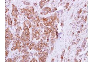 IHC-P Image Immunohistochemical analysis of paraffin-embedded human breast cancer, using OCRL, antibody at 1:250 dilution. (OCRL Antikörper  (C-Term))