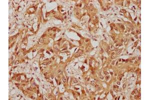 IHC image of ABIN7174320 diluted at 1:100 and staining in paraffin-embedded human liver cancer performed on a Leica BondTM system. (USP36 Antikörper  (AA 670-881))