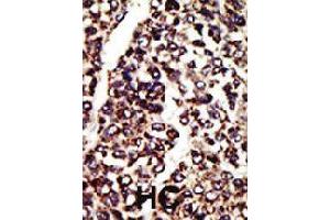 Formalin-fixed and paraffin-embedded human hepatocellular carcinoma tissue reacted with AGER polyclonal antibody  , which was peroxidase-conjugated to the secondary antibody, followed by AEC staining . (RAGE Antikörper  (C-Term))