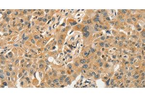 Immunohistochemistry of paraffin-embedded Human lung cancer tissue using SLC11A2 Polyclonal Antibody at dilution 1:50 (SLC11A2 Antikörper)