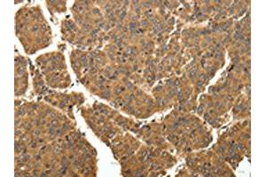 The image on the left is immunohistochemistry of paraffin-embedded Human liver cancer tissue using ABIN7129340(EIF2AK3 Antibody) at dilution 1/40, on the right is treated with fusion protein. (COQ3 Antikörper)