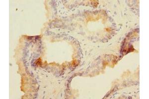 Immunohistochemistry of paraffin-embedded human prostate cancer using ABIN7160074 at dilution of 1:100 (MAP4K5 Antikörper  (AA 300-480))