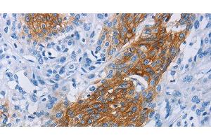 Immunohistochemistry of paraffin-embedded Human esophagus cancer tissue using CCR9 Polyclonal Antibody at dilution 1:60 (CCR9 Antikörper)