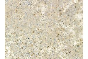 ABIN6264150 and ABIN6277603 at 1/100 staining human melanoma by IHC-P. (PEX19 Antikörper  (Internal Region))