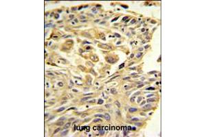 ZO1 Antibody IHC analysis in formalin fixed and paraffin embedded lung carcinoma followed by peroxidase conjugation of the secondary antibody and DAB staining. (TJP1 Antikörper  (C-Term))