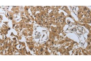 Immunohistochemistry of paraffin-embedded Human lung cancer using PSMD6 Polyclonal Antibody at dilution of 1:40 (PSMD6 Antikörper)