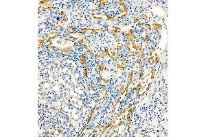 Immunohistochemistry of paraffin embedded human lung cancer using MRP1 (ABIN7074544) at dilution of 1:1000 (200x lens) (MRP1 Antikörper)