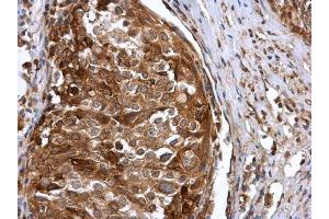IHC-P Image IFIT3 antibody detects IFIT3 protein at cytoplasm in human cervical carcinoma by immunohistochemical analysis. (IFIT3 Antikörper)