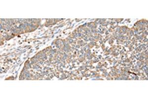 Immunohistochemistry of paraffin-embedded Human lung cancer tissue using DPH7 Polyclonal Antibody at dilution of 1:40(x200)