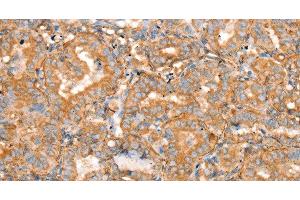 Immunohistochemistry of paraffin-embedded Human thyroid cancer using SLC16A8 Polyclonal Antibody at dilution of 1:40 (MCT3 Antikörper)