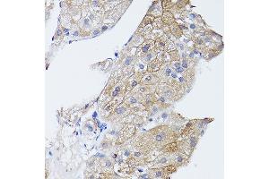 Immunohistochemistry of paraffin-embedded human liver cancer using GN Rabbit pAb (ABIN3023414, ABIN3023415, ABIN3023416 and ABIN6219781) at dilution of 1:150 (40x lens).