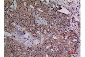 Immunohistochemistry (IHC) analysis of paraffin-embedded Human Breast Cancer, antibody was diluted at 1:100. (IL-4 Antikörper  (Internal Region))