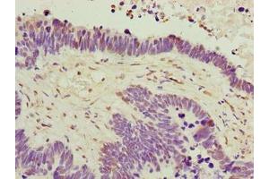 Immunohistochemistry of paraffin-embedded human ovarian cancer using ABIN7174864 at dilution of 1:100 (C6orf141 Antikörper  (AA 1-237))